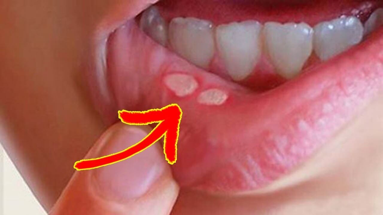 5 phương pháp chữa nhiệt miệng đơn giản mà hiệu quả 1