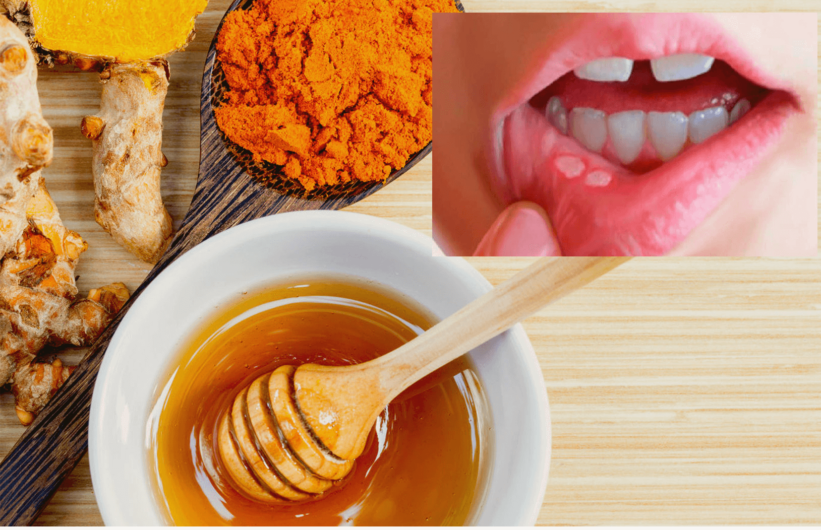 5 phương pháp chữa nhiệt miệng đơn giản mà hiệu quả 2