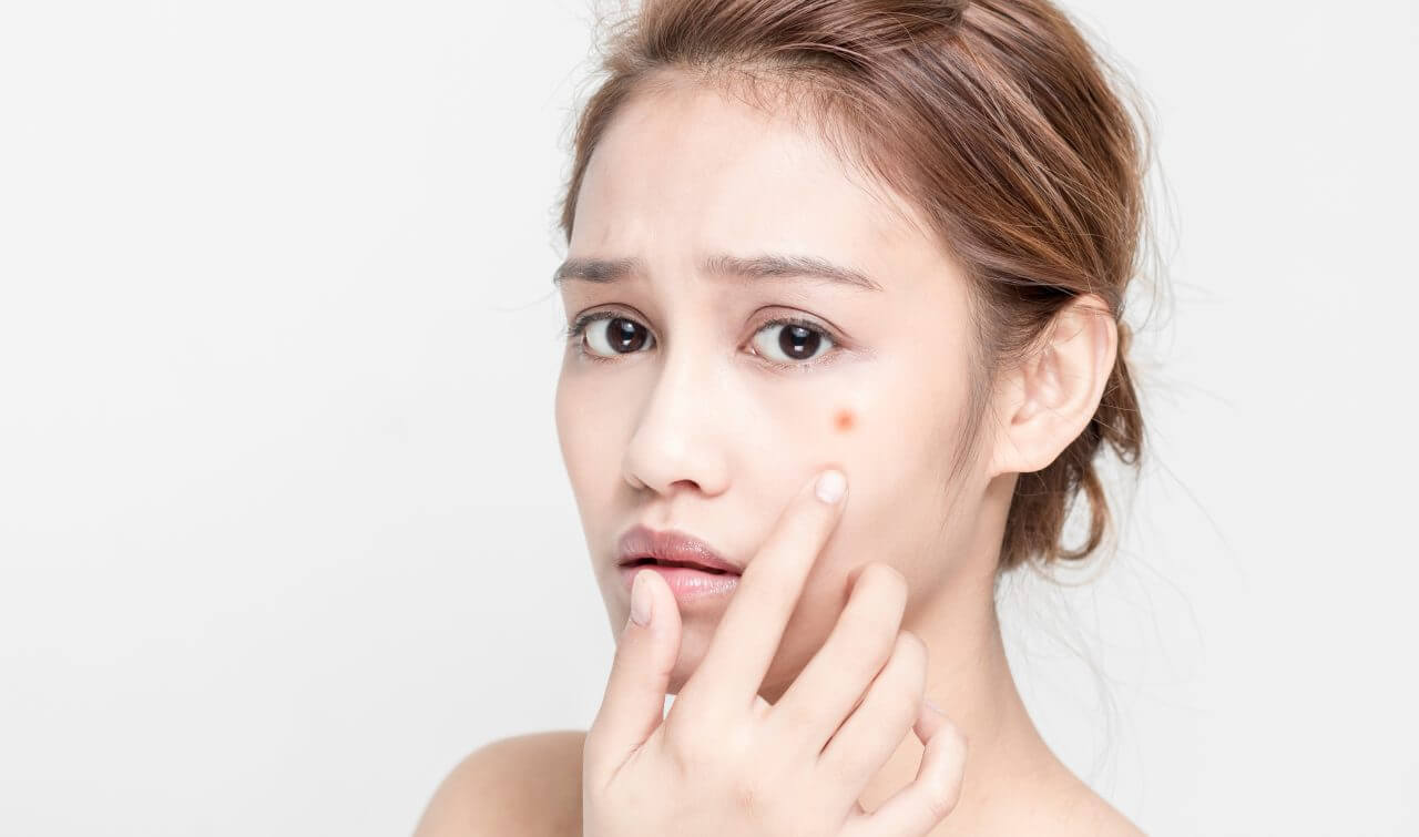 03 nguyên nhân gây mụn trứng cá 3