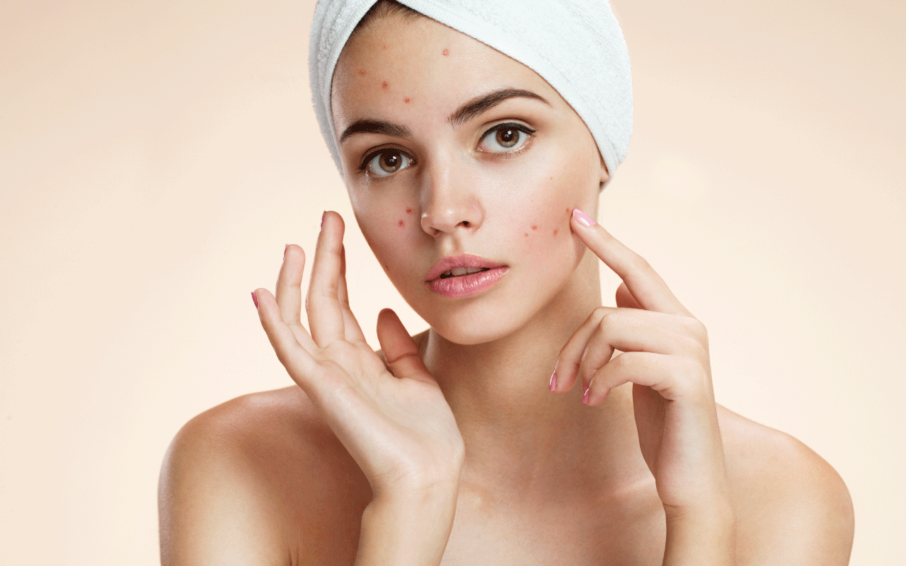 Hiểu rõ về mụn trứng cá & cách phòng tránh 1
