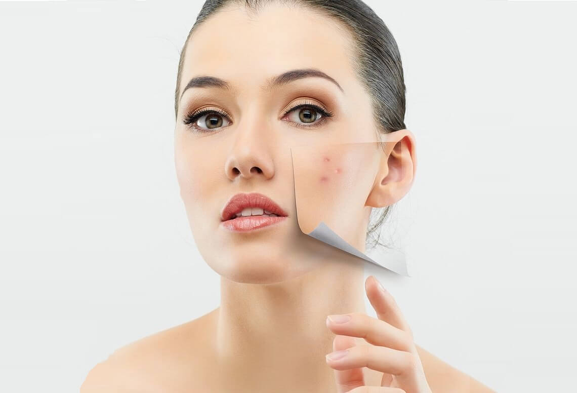 Hiểu rõ về mụn trứng cá & cách phòng tránh 2