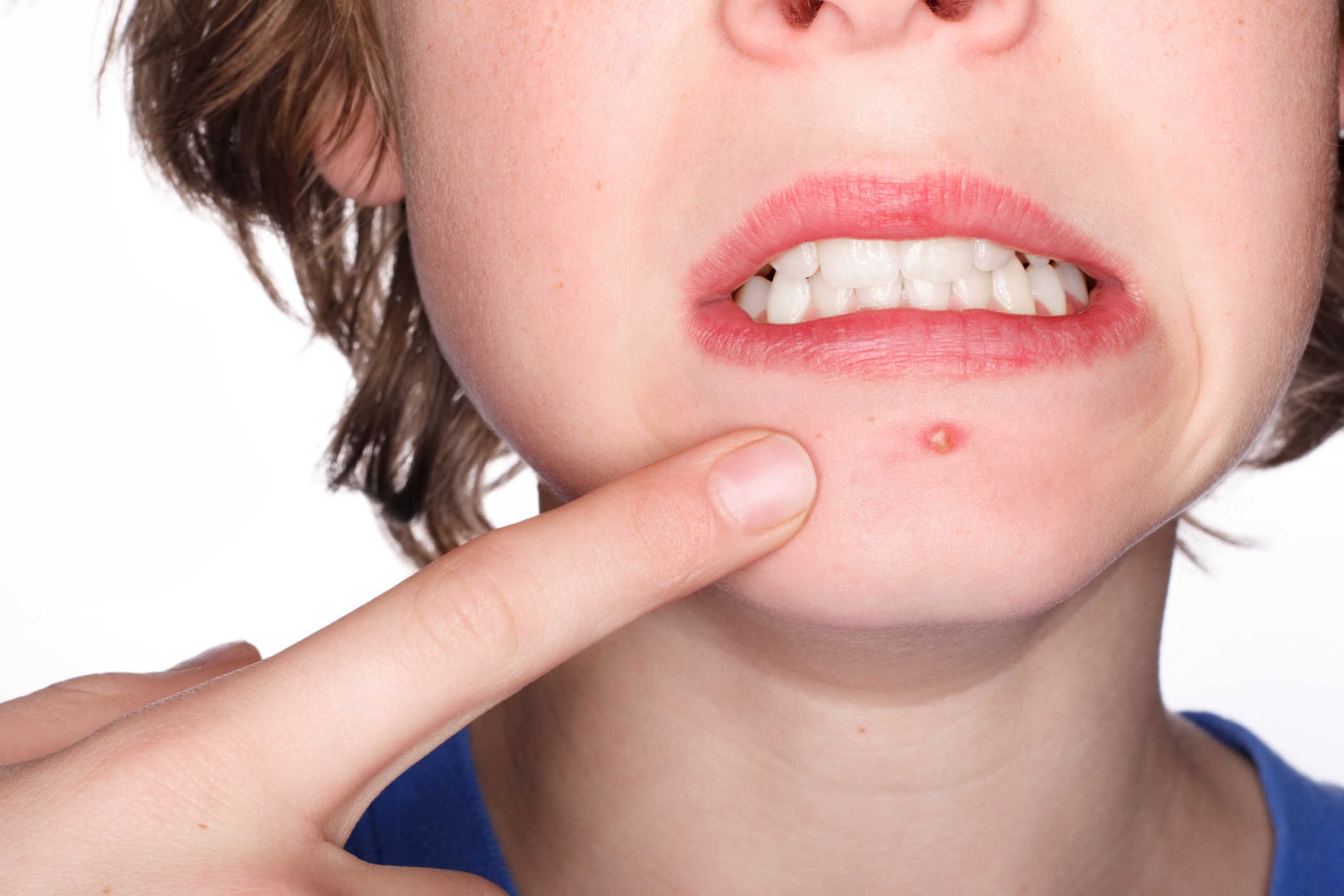 Hiểu rõ về mụn trứng cá & cách phòng tránh 3