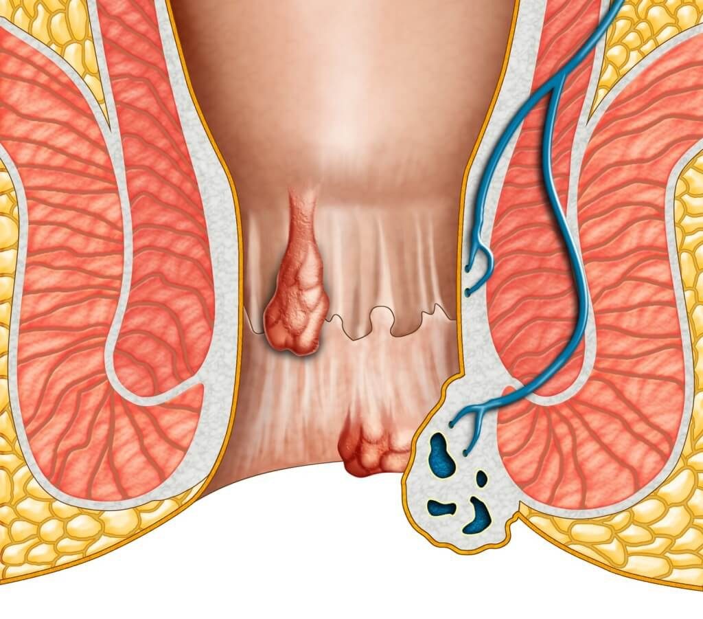 Đi cầu ra máu tươi là bệnh gì? Có nguy hiểm không? 2