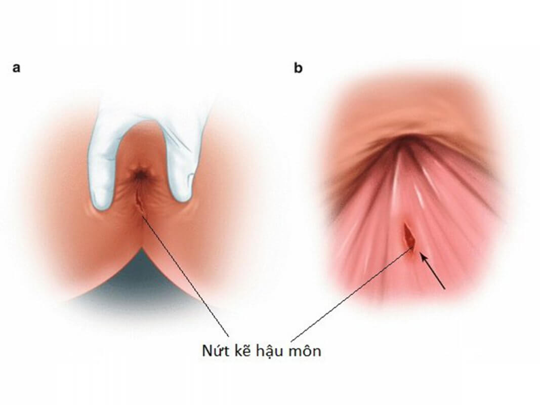Đi cầu ra máu tươi là bệnh gì? Có nguy hiểm không? 3