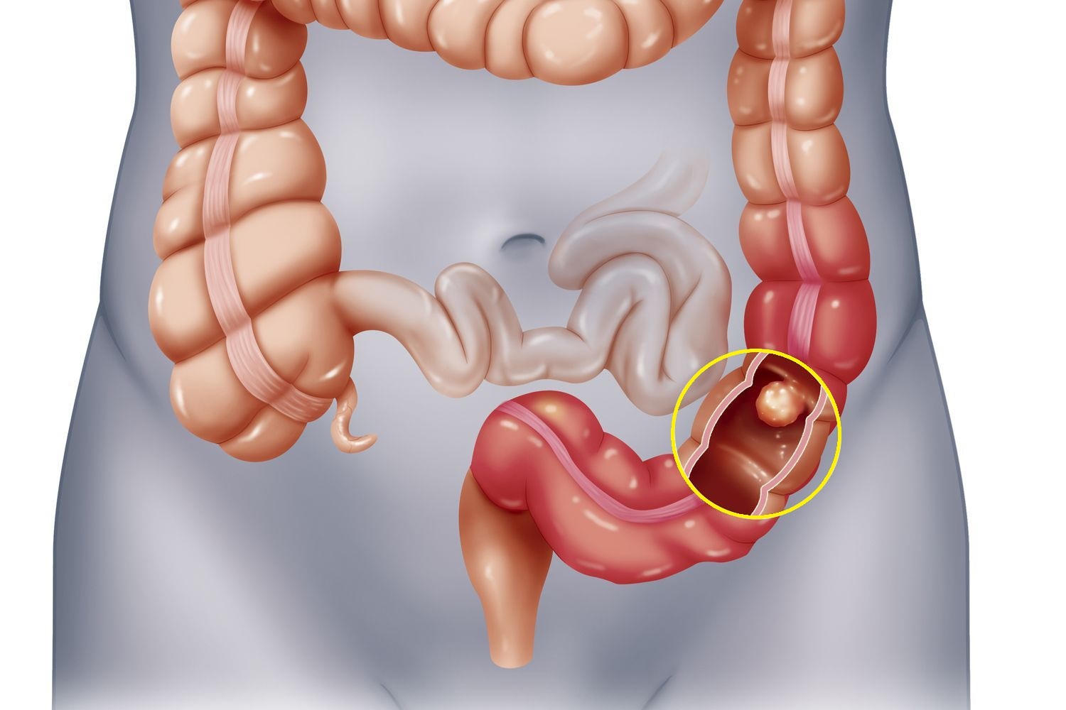 Đi cầu ra máu tươi là bệnh gì? Có nguy hiểm không? 5