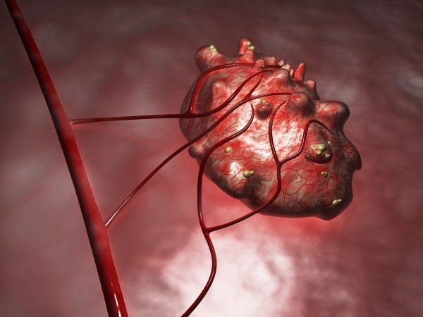  Mạch máu của nang bị vỡ là nguyên nhân gây bệnh