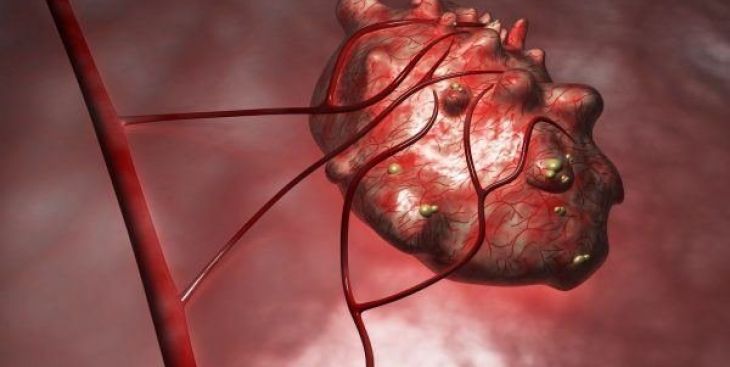 Nguyên nhân u nang buồng trứng và triệu chứng thường gặp