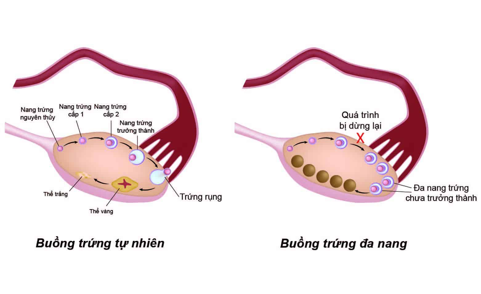  Bệnh nang buồng trứng 2 bên