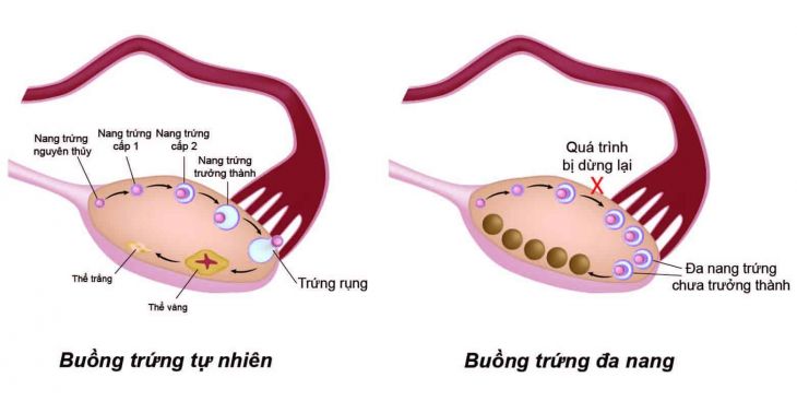Những thông tin cần biết về nang buồng trứng 2 bên