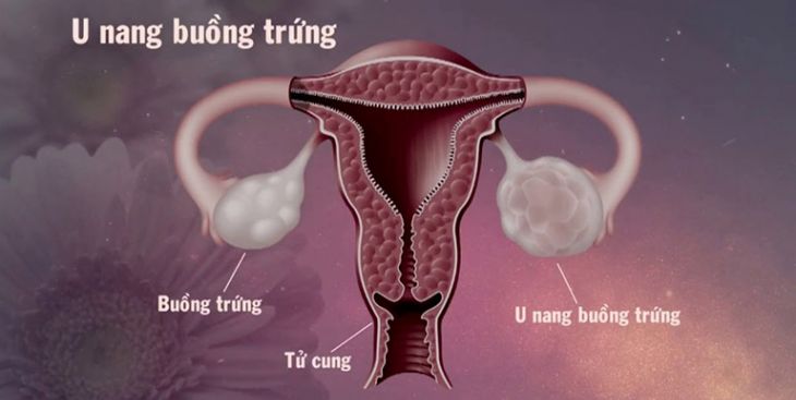 Những thông tin cần biết về nang trứng