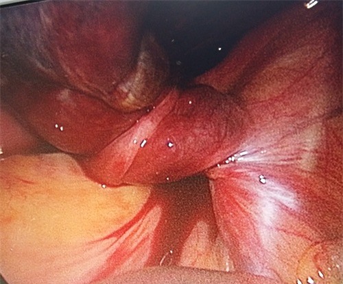 Xoắn nang buồng trứng