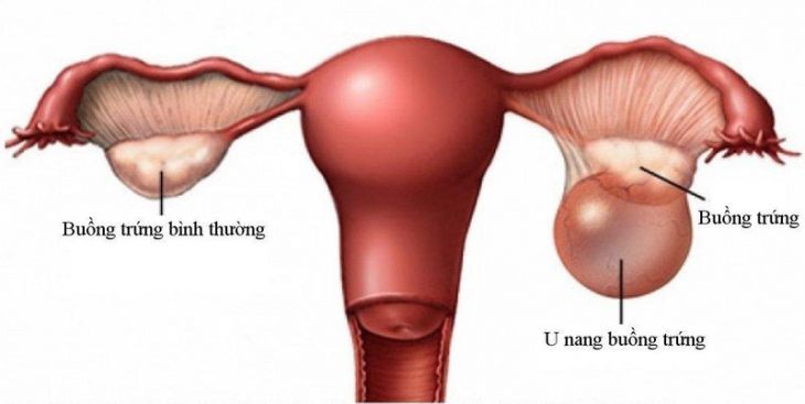 Tìm hiểu về nang chức năng buồng trứng 