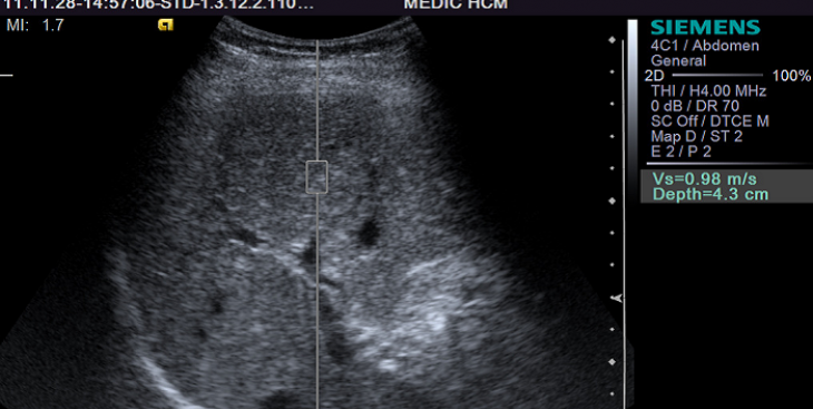 Nang trống âm buồng trứng phải là bệnh gì? Có nguy hiểm không?