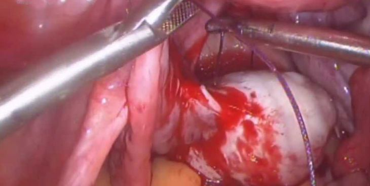 U nang buồng trứng xoắn là bệnh gì? Có nguy hiểm không?