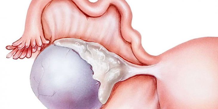 U nang nhầy buồng trứng là bệnh gì? Có nguy hiểm không?