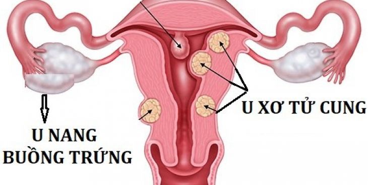 Những điều cần biết về u xơ tử cung, u nang buồng trứng