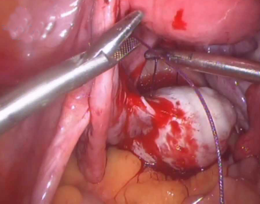 U nang buồng trứng xoắn