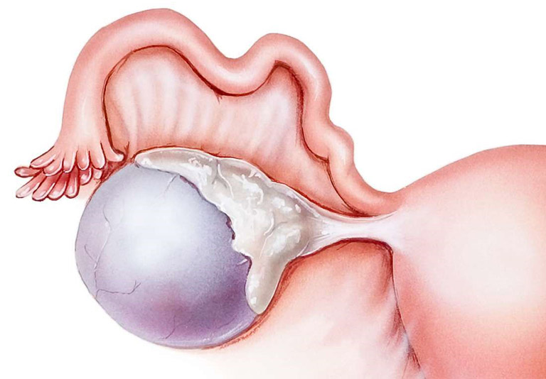 U nang nhầy buồng trứng