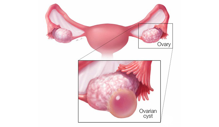 Hình ảnh u nang nước buồng trứng