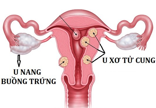 U xơ buồng trứng