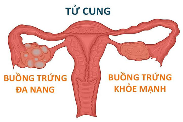  U nang buồng trứng khi có thai gây nhiều ảnh hưởng