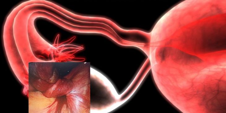 Giải đáp thắc mắc nang buồng trứng phải có nguy hiểm không?