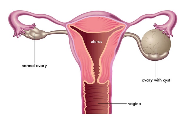 Bệnh có thể gây ra một số biến chứng