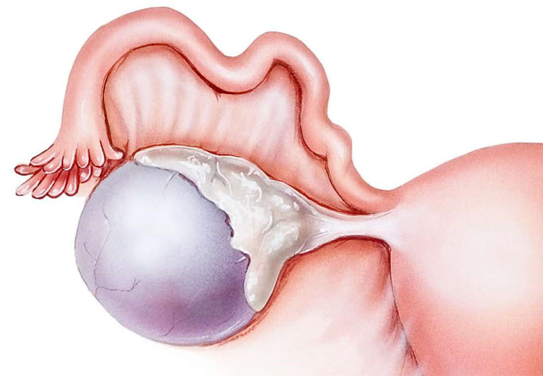  Khối u nang buồng trứng trái 