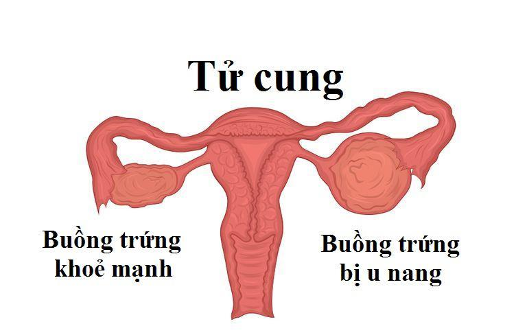 Nang hoàng thể buồng trứng phải xuất huyết là tình trạng bệnh bình thường