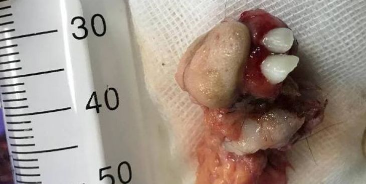 Tìm hiểu về u nang bì buồng trứng và cách điều trị