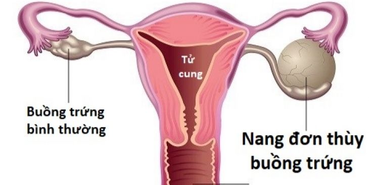 Nang đơn thùy buồng trứng trái: Dấu hiệu và cách điều trị