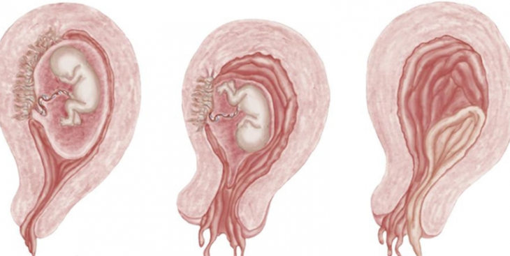 Buồng trứng phải có nang khi mang thai có nguy hiểm không?