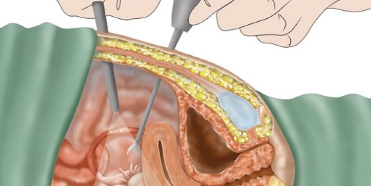 Cách trị u nang buồng trứng bên phải ai cũng nên biết