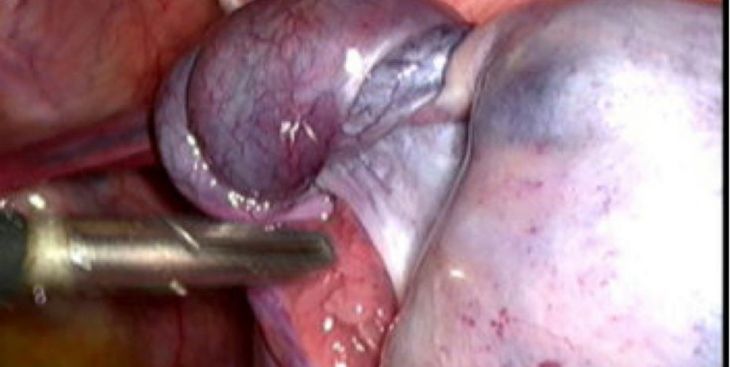 Các biện pháp điều trị u nang buồng trứng xoắn