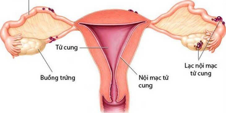U nang lạc nội mạc buồng trứng trái là bệnh gì? Có nguy hiểm không?