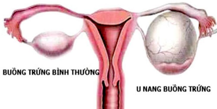 U nang bì buồng trứng có thai được không?