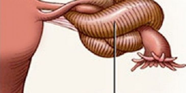 Tìm hiểu về tình trạng xoắn buồng trứng khi mang thai