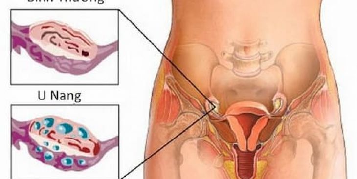 Những biến chứng của u nang buồng trứng