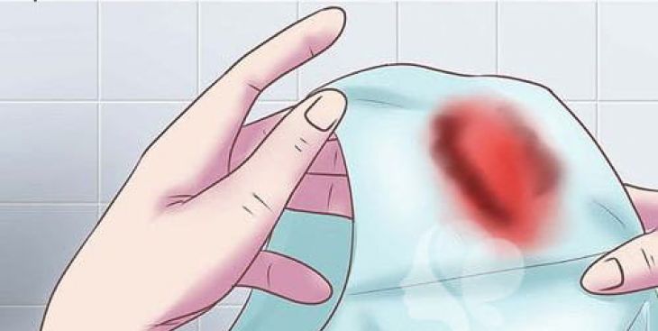 Chảy máu buồng trứng là bệnh gì? Những điều cần biết