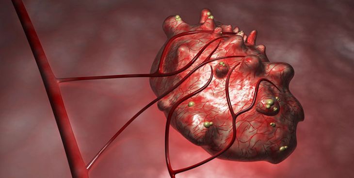 Phương pháp điều trị u nang buồng trứng có chồi