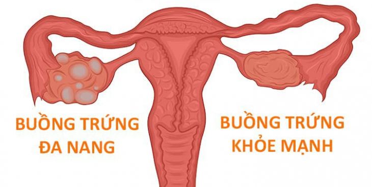 Buồng trứng có nang nhỏ là bệnh gì? Nguyên nhân và biểu hiện của bệnh