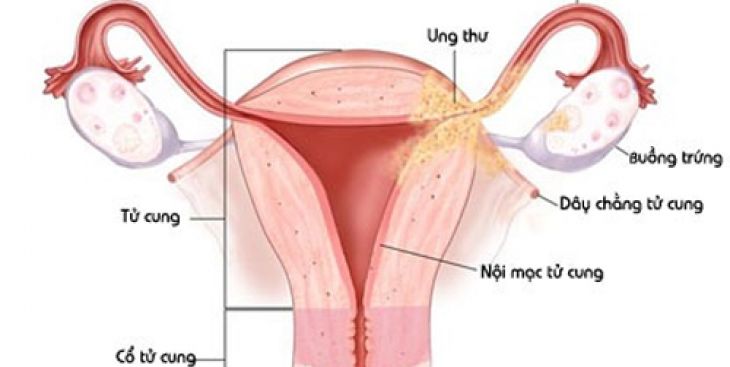 Nang lạc tuyến buồng trứng trái: Nguyên nhân, triệu chứng & cách điều trị bệnh hiệu quả