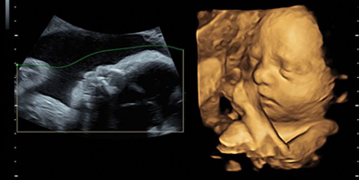 Thai nhi bị u nang buồng trứng: Nguyên nhân và cách phòng tránh