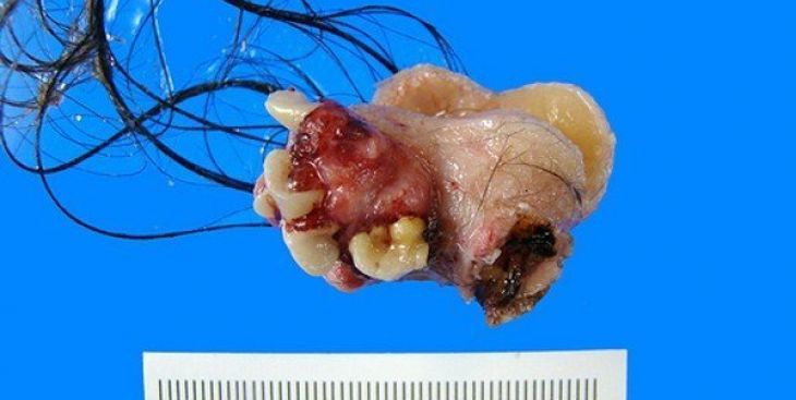 U biểu bì buồng trứng là bệnh gì? Có nguy hiểm không?