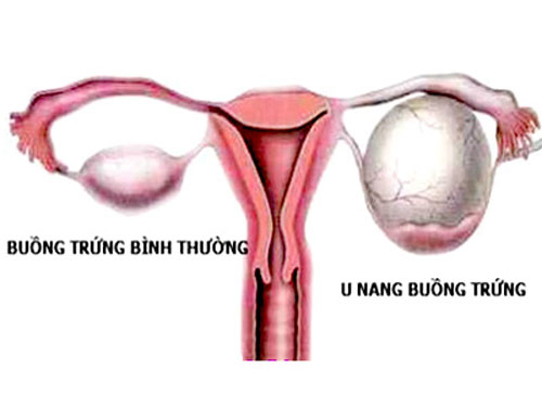 U nang buồng trứng là bệnh phụ khoa thường gặp
